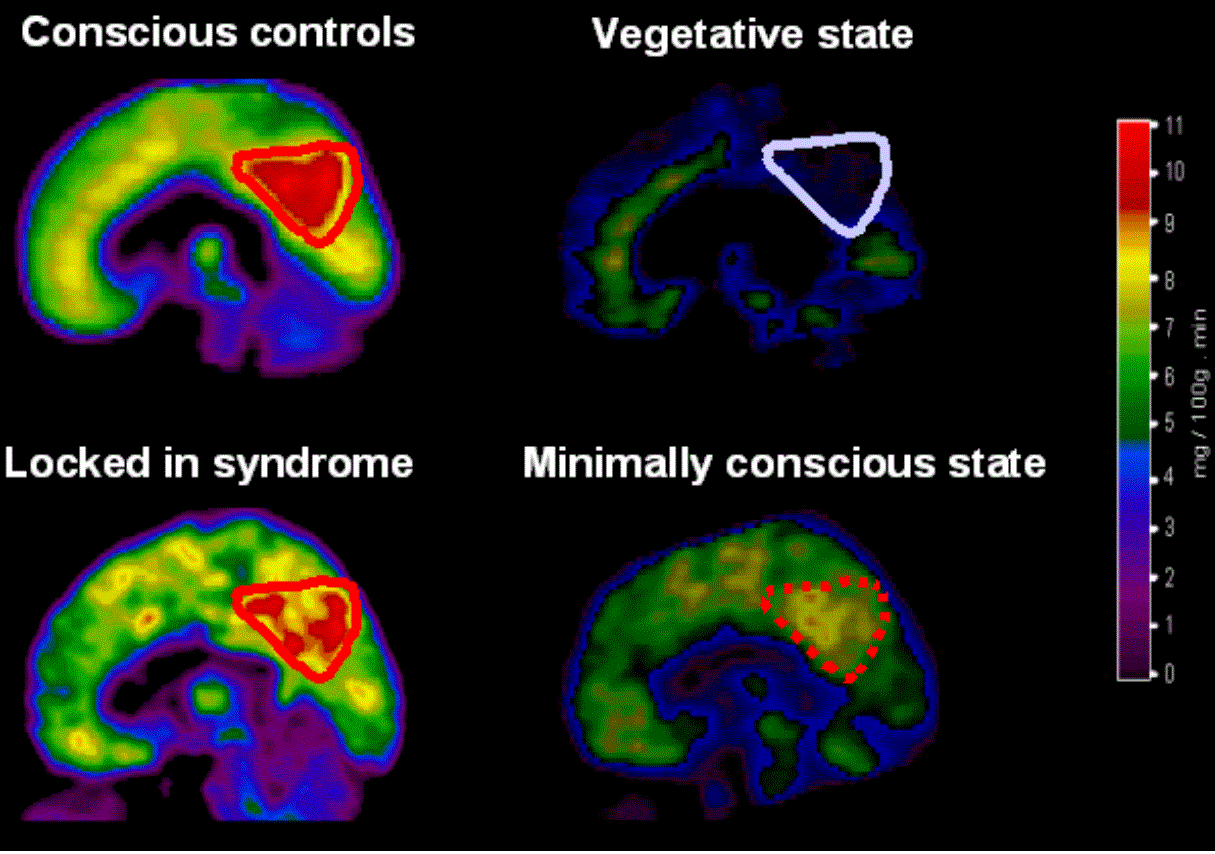 Consciousness in the persistent vegetative state